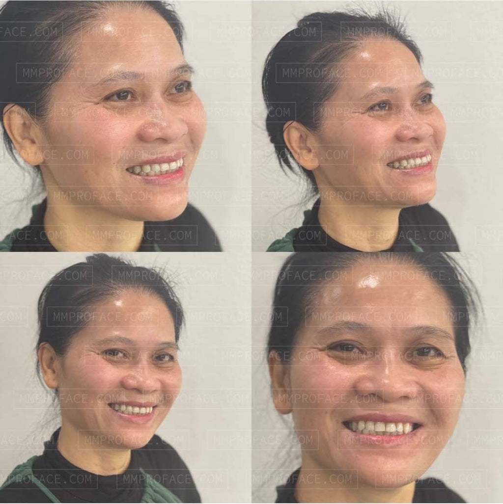 Peel da tăng cường sức khỏe làn da Skinbetter AlphaRet Professional Peel System 50