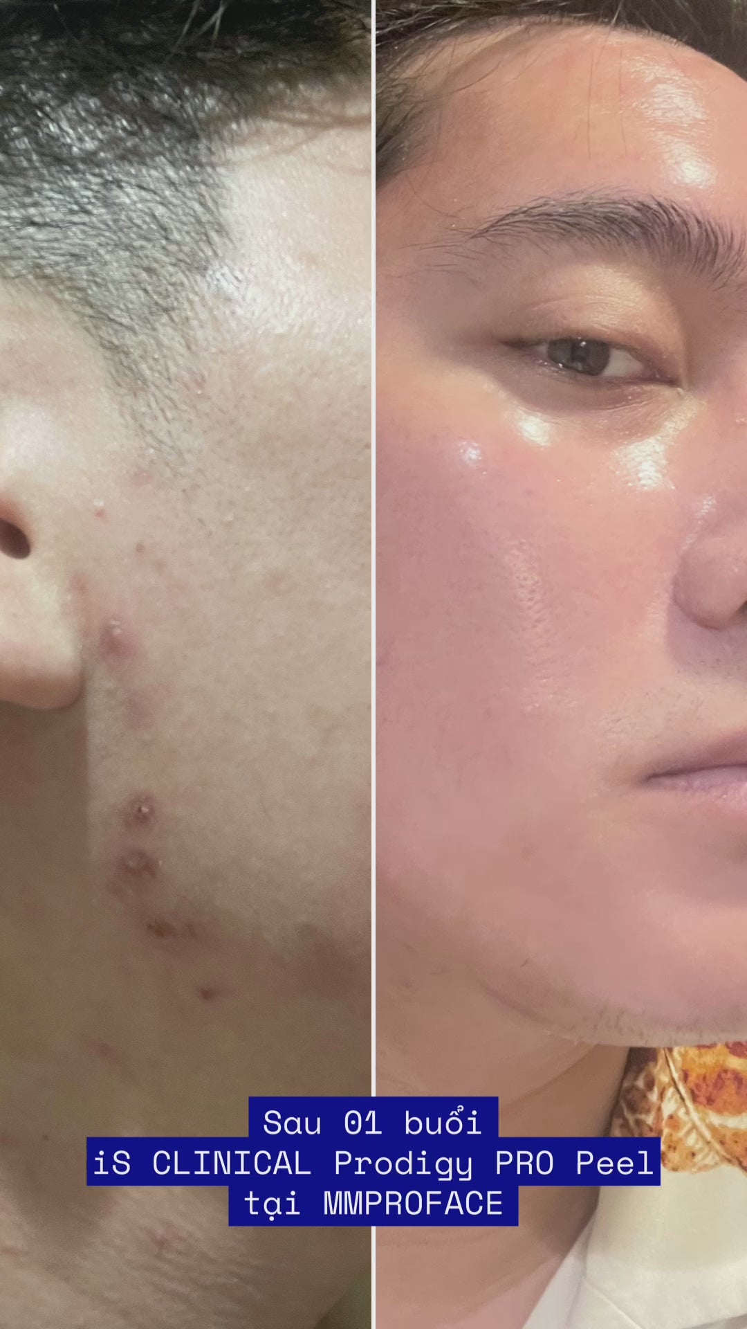 Peel da chuyên sâu cải thiện sắc tố và đảo ngược lão hóa toàn diện iS Clinical Prodigy Peel PRO P3