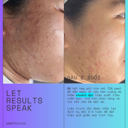 Peel da trị sẹo và trẻ hóa toàn diện WIQO PRX-T33